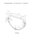 ADJUSTABLE IMPLANT SYSTEM diagram and image