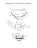 ADJUSTABLE IMPLANT SYSTEM diagram and image