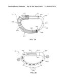 ADJUSTABLE IMPLANT SYSTEM diagram and image