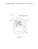 ADJUSTABLE IMPLANT SYSTEM diagram and image