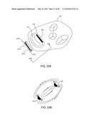 ADJUSTABLE IMPLANT SYSTEM diagram and image