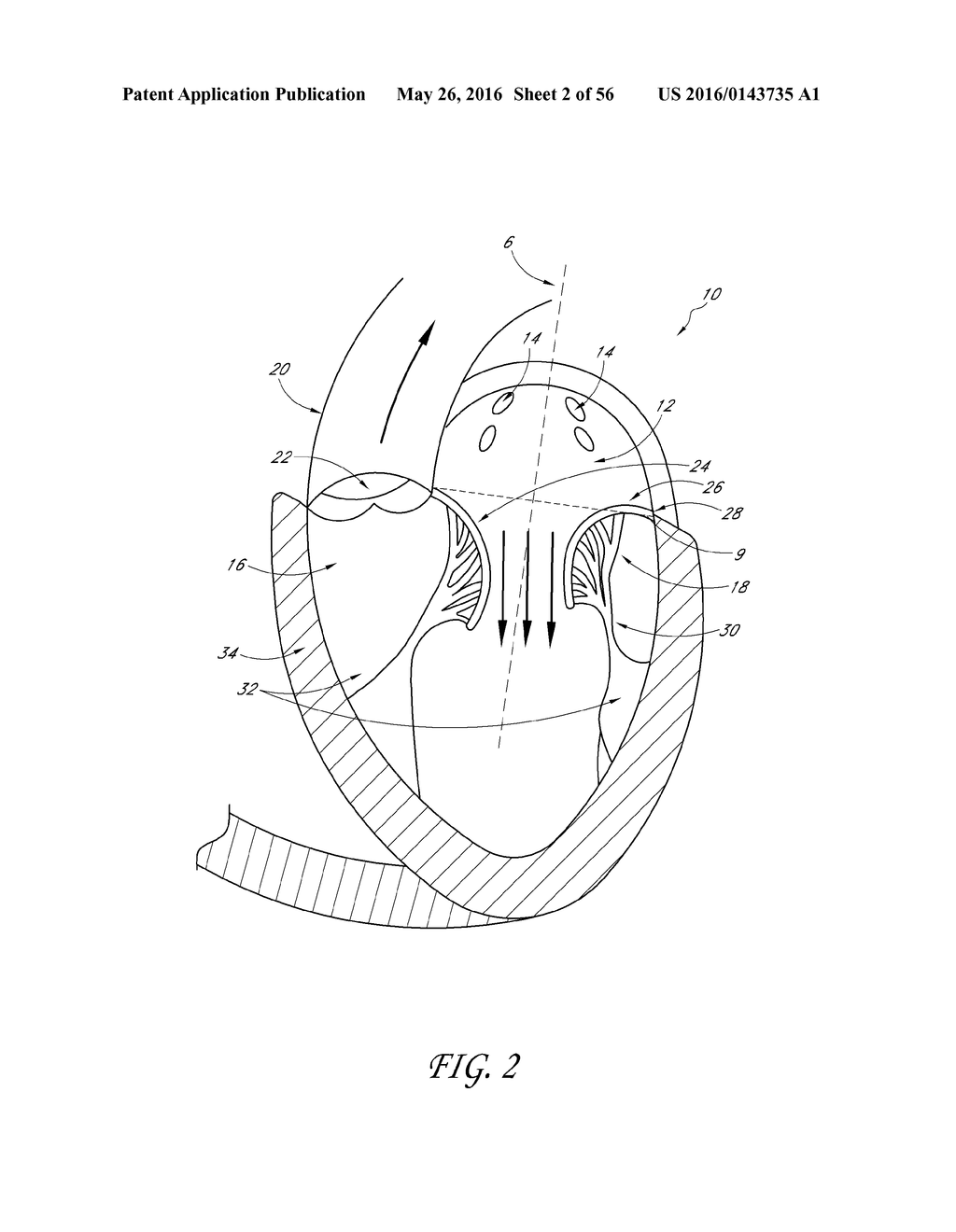 TRANSVALVULAR INTRAANNULAR BAND FOR VALVE REPAIR - diagram, schematic, and image 03