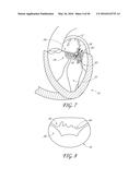 TRANSVALVULAR INTRAANNULAR BAND FOR VALVE REPAIR diagram and image