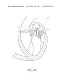 TRANSVALVULAR INTRAANNULAR BAND FOR VALVE REPAIR diagram and image