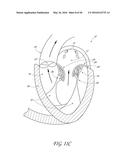 TRANSVALVULAR INTRAANNULAR BAND FOR VALVE REPAIR diagram and image