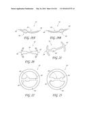 TRANSVALVULAR INTRAANNULAR BAND FOR VALVE REPAIR diagram and image