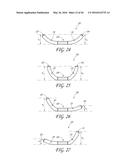 TRANSVALVULAR INTRAANNULAR BAND FOR VALVE REPAIR diagram and image