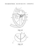 TRANSVALVULAR INTRAANNULAR BAND FOR VALVE REPAIR diagram and image