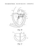 TRANSVALVULAR INTRAANNULAR BAND FOR VALVE REPAIR diagram and image