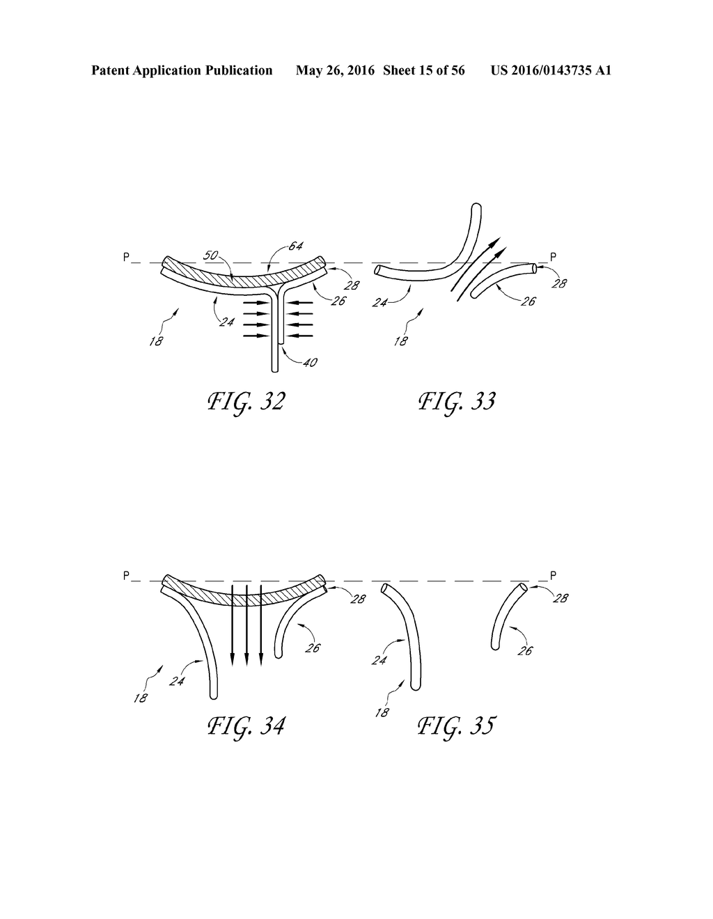 TRANSVALVULAR INTRAANNULAR BAND FOR VALVE REPAIR - diagram, schematic, and image 16