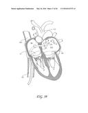 TRANSVALVULAR INTRAANNULAR BAND FOR VALVE REPAIR diagram and image