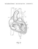 TRANSVALVULAR INTRAANNULAR BAND FOR VALVE REPAIR diagram and image