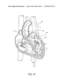 TRANSVALVULAR INTRAANNULAR BAND FOR VALVE REPAIR diagram and image