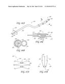 TRANSVALVULAR INTRAANNULAR BAND FOR VALVE REPAIR diagram and image