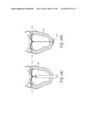 TRANSVALVULAR INTRAANNULAR BAND FOR VALVE REPAIR diagram and image