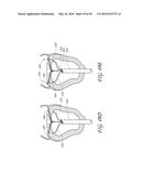 TRANSVALVULAR INTRAANNULAR BAND FOR VALVE REPAIR diagram and image