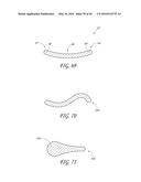 TRANSVALVULAR INTRAANNULAR BAND FOR VALVE REPAIR diagram and image