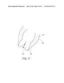 TRANSVALVULAR INTRAANNULAR BAND FOR VALVE REPAIR diagram and image