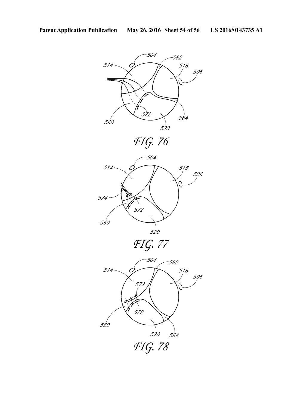 TRANSVALVULAR INTRAANNULAR BAND FOR VALVE REPAIR - diagram, schematic, and image 55