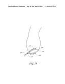 TRANSVALVULAR INTRAANNULAR BAND FOR VALVE REPAIR diagram and image