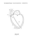 TRANSVALVULAR INTRAANNULAR BAND FOR VALVE REPAIR diagram and image