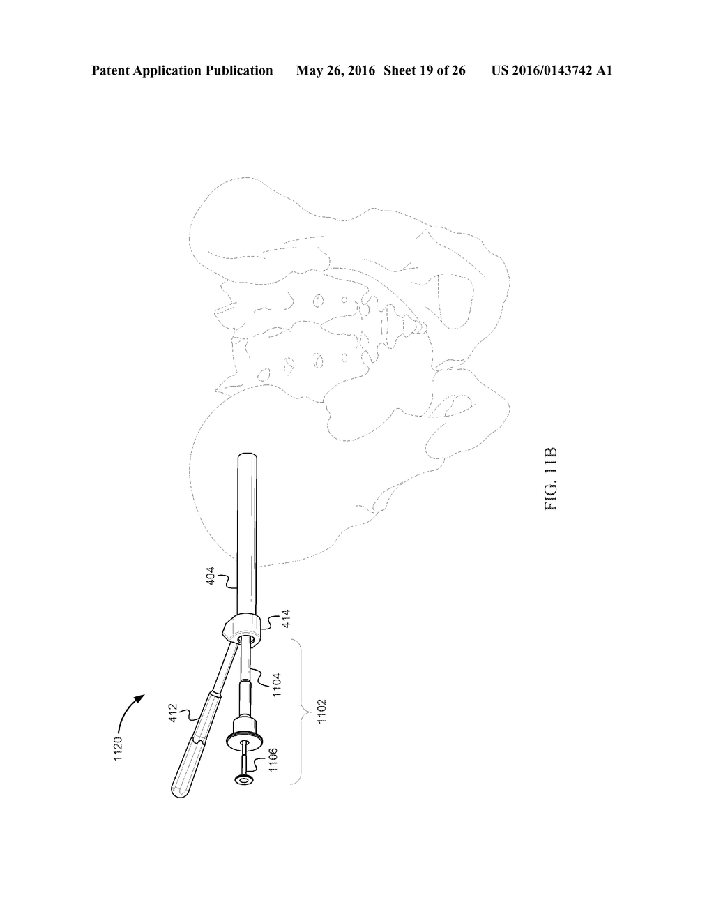 JOINT FUSION - diagram, schematic, and image 20