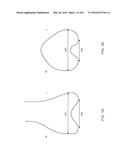 Patient-Adapted and Improved Articular Implants, Designs and Related Guide     Tools diagram and image