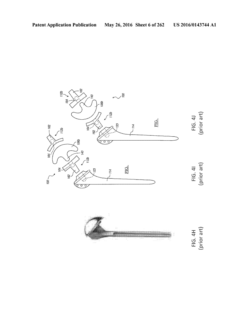 Patient-Adapted and Improved Articular Implants, Designs and Related Guide     Tools - diagram, schematic, and image 07