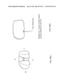 Patient-Adapted and Improved Articular Implants, Designs and Related Guide     Tools diagram and image