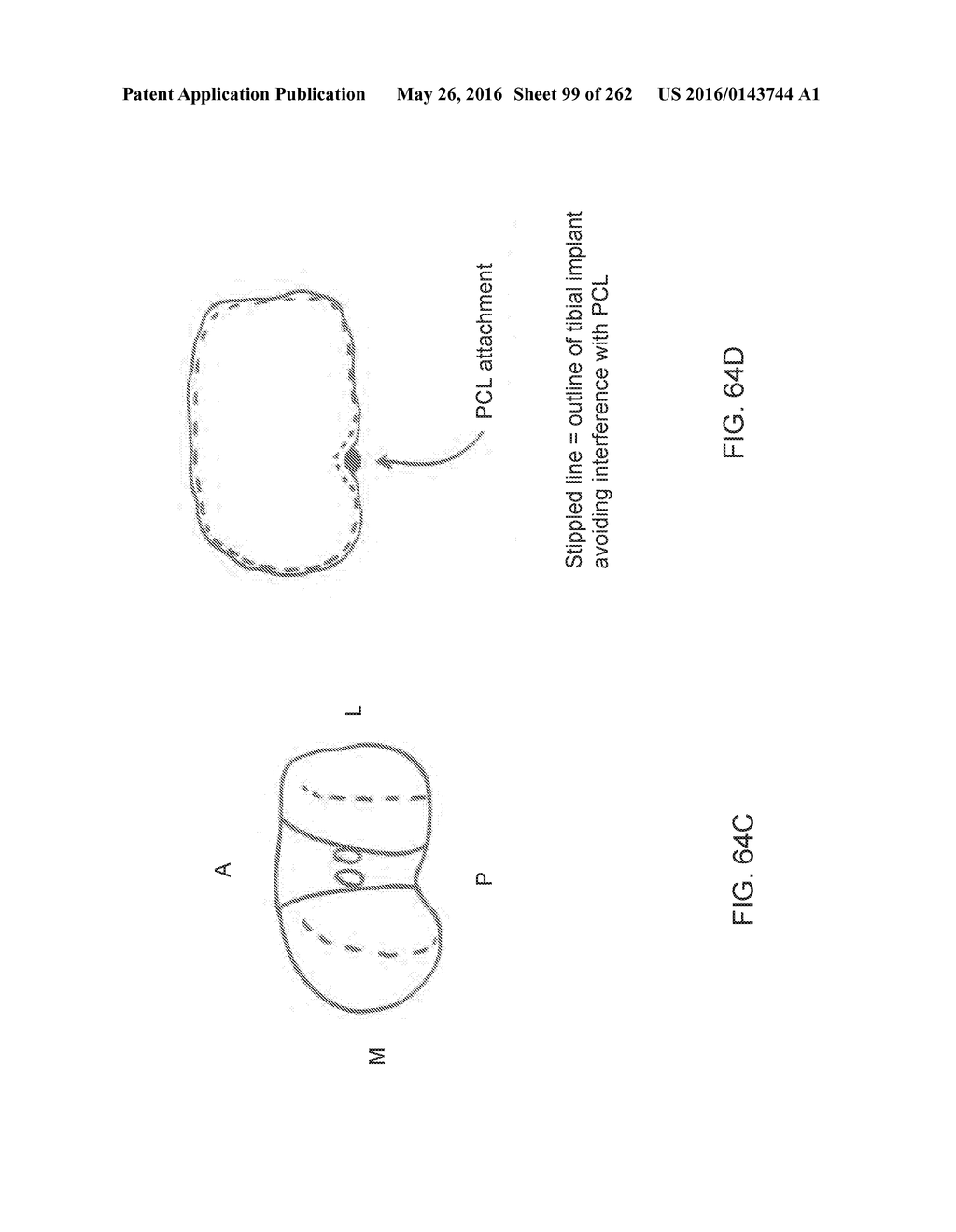 Patient-Adapted and Improved Articular Implants, Designs and Related Guide     Tools - diagram, schematic, and image 100