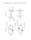 Patient-Adapted and Improved Articular Implants, Designs and Related Guide     Tools diagram and image