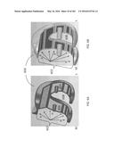 Patient-Adapted and Improved Articular Implants, Designs and Related Guide     Tools diagram and image