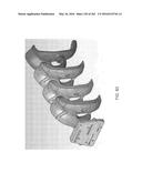 Patient-Adapted and Improved Articular Implants, Designs and Related Guide     Tools diagram and image