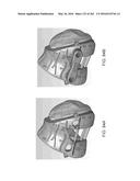 Patient-Adapted and Improved Articular Implants, Designs and Related Guide     Tools diagram and image