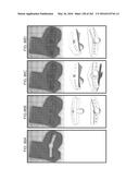 Patient-Adapted and Improved Articular Implants, Designs and Related Guide     Tools diagram and image