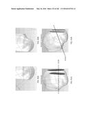 Patient-Adapted and Improved Articular Implants, Designs and Related Guide     Tools diagram and image