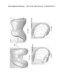 Patient-Adapted and Improved Articular Implants, Designs and Related Guide     Tools diagram and image