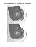 Patient-Adapted and Improved Articular Implants, Designs and Related Guide     Tools diagram and image