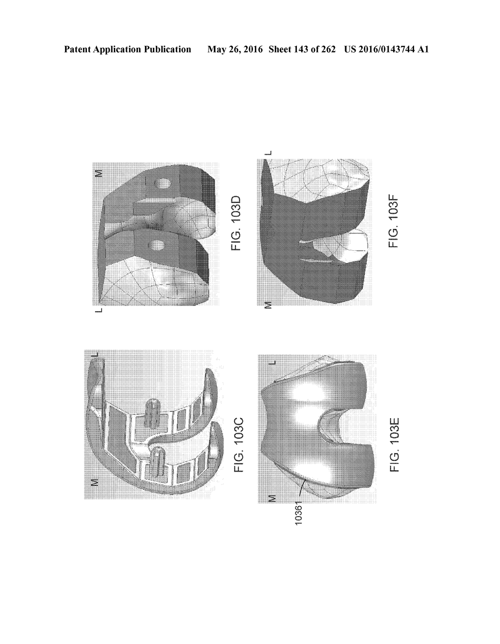 Patient-Adapted and Improved Articular Implants, Designs and Related Guide     Tools - diagram, schematic, and image 144