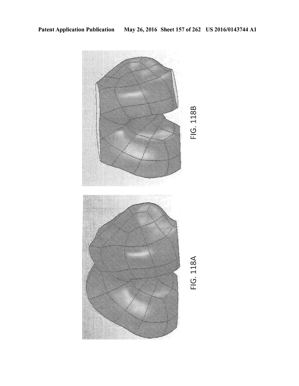 Patient-Adapted and Improved Articular Implants, Designs and Related Guide     Tools - diagram, schematic, and image 158