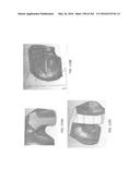 Patient-Adapted and Improved Articular Implants, Designs and Related Guide     Tools diagram and image