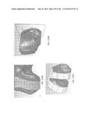 Patient-Adapted and Improved Articular Implants, Designs and Related Guide     Tools diagram and image