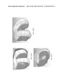 Patient-Adapted and Improved Articular Implants, Designs and Related Guide     Tools diagram and image