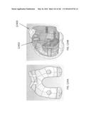 Patient-Adapted and Improved Articular Implants, Designs and Related Guide     Tools diagram and image