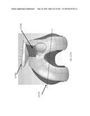 Patient-Adapted and Improved Articular Implants, Designs and Related Guide     Tools diagram and image