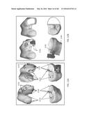 Patient-Adapted and Improved Articular Implants, Designs and Related Guide     Tools diagram and image