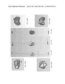 Patient-Adapted and Improved Articular Implants, Designs and Related Guide     Tools diagram and image