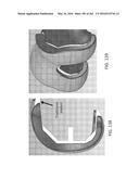 Patient-Adapted and Improved Articular Implants, Designs and Related Guide     Tools diagram and image