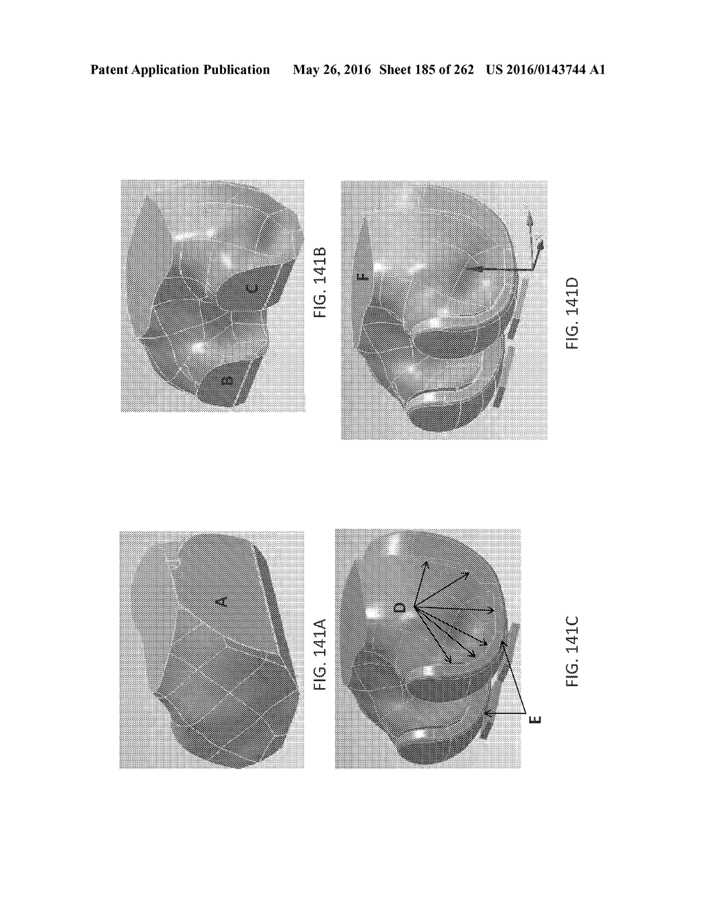 Patient-Adapted and Improved Articular Implants, Designs and Related Guide     Tools - diagram, schematic, and image 186