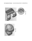 Patient-Adapted and Improved Articular Implants, Designs and Related Guide     Tools diagram and image